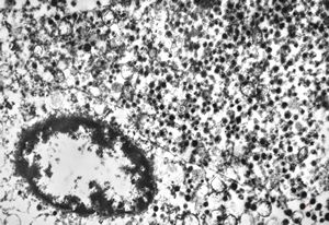 F,79y. | paraganglioma - ileum F,79y. | paraganglioma - ileum